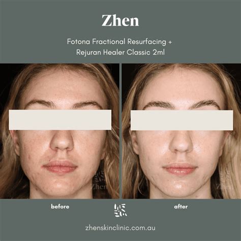 Fotona Fractional Laser Resurfacing | Zhen Skin Clinic