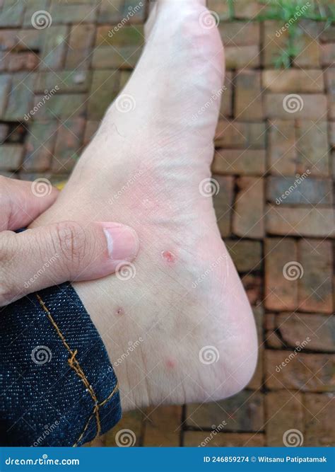 Mosquito Bites On Feet Won't Go Away at Maddison Pickworth blog