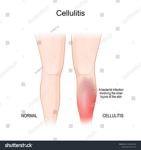 Cellulitis Infection