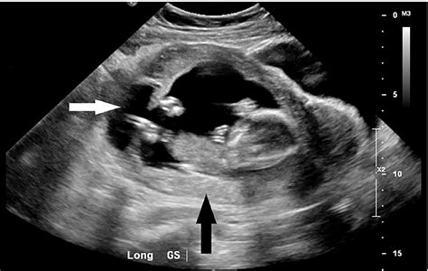 9 Week Ectopic Pregnancy Ultrasound