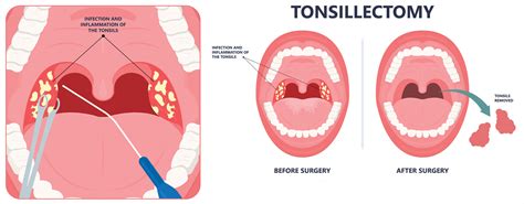 Tonsillectomy For Tonsil Stones