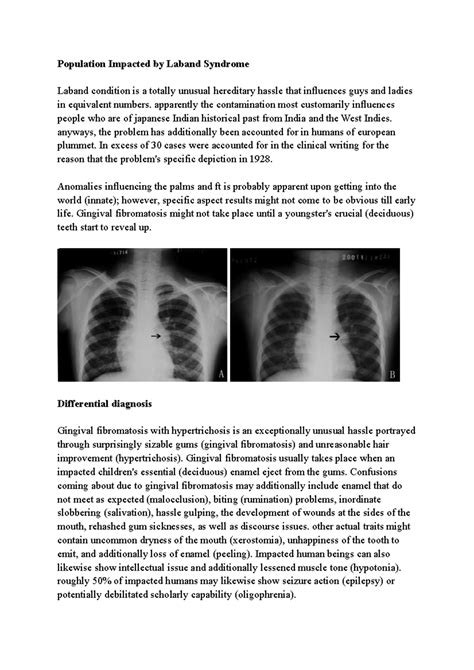 Diagnosis and treatment of Laband Syndrome - Population Impacted by ...