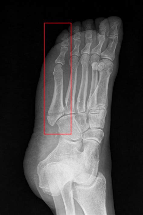 Base of fifth metatarsal fracture - monkeysrat