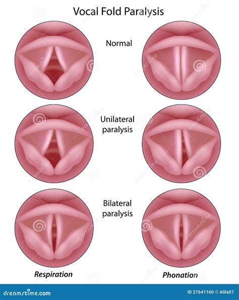 Vocal Cord Paralysis Stock Photo - Image: 27641160