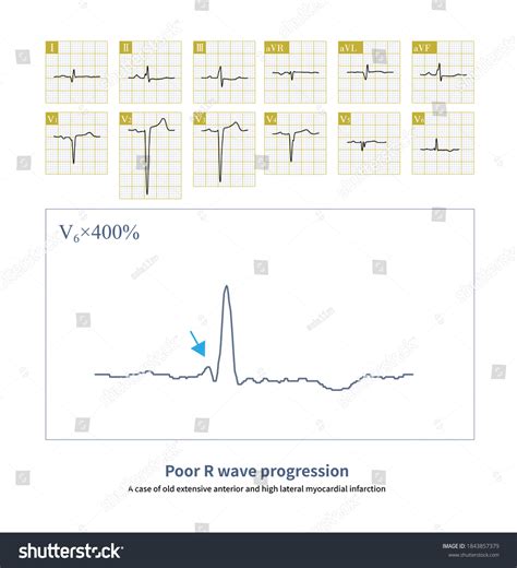 9 imagens de Poor r wave progression Imagens, fotos stock e vetores ...