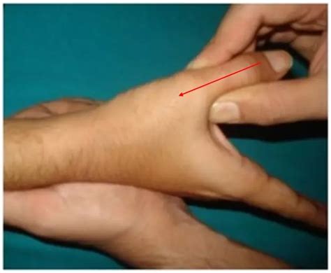 Scaphoid Fracture Test 的图像结果