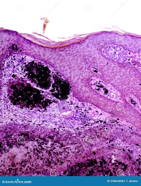 Intradermal Pigmented Nevus Stock Image - Image of keratinocytes ...