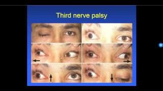 Image result for Intractable Diplopia