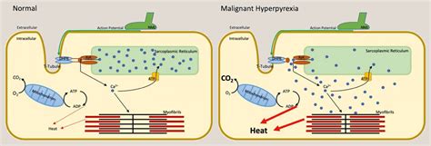 Malignant hyperthermia - Anaesthesia & Intensive Care Medicine