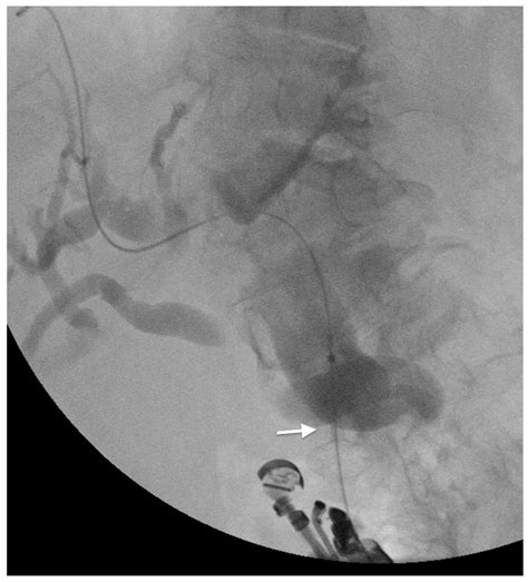 Palliation in Gallbladder Cancer: The Role of Gastrointestinal Endoscopy