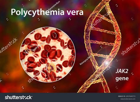 Polycythemia Vera Rare Blood Cancer Increase Stock Illustration 2057640773 | Shutterstock