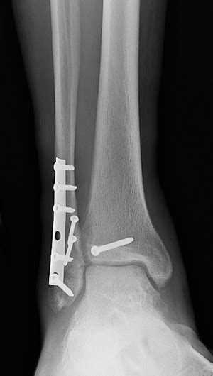 Broken Ankle: Types of Fractures, Diagnosis & Treatments | HSS