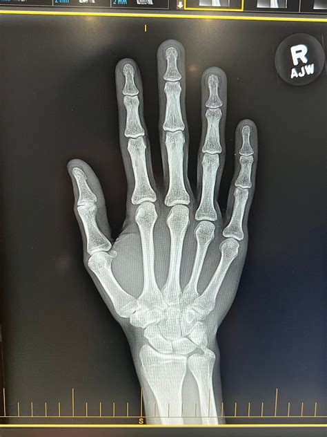 Lingering Thumb Pain (MCP joint area and some IP joint). MRI Report ...