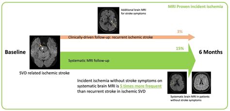 MRI-Proven Incident Ischemia: A New Marker of Disease Progression in Small Vessel Diseases | Stroke