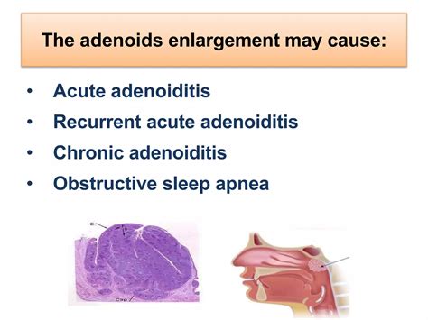 Adenoid Enlargement in children.pptx