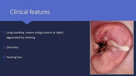 Malignant Otitis Externa | PPTX