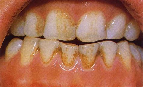 Image result for Teeth Staining Causes