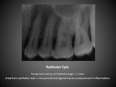 Academy of Dental Knowledge: Periapical/Radicular Cyst