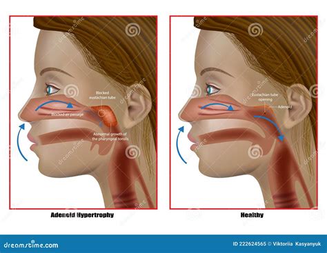 Adenoid Hypertrophy, the Abnormal Growth of the Pharyngeal Tonsils. Adenoidectomy. Eustachian ...