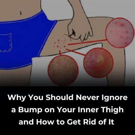 The Most Effective Ways to Get Rid of Bumps on Inner Thigh (Backed by ...