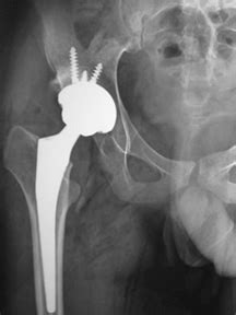 Hip Replacement: Dysplasia treatment Chennai |Bone grafting surgery ...