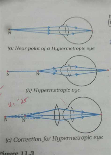 A person suffering from a defect of vision uses a corrective lens of ...