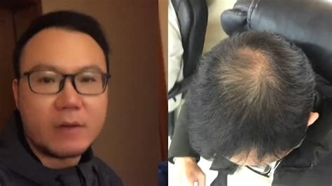 男子坚持半年不用洗发水，从秃顶变满头黑发，晒视频对比前后变化_新浪新闻