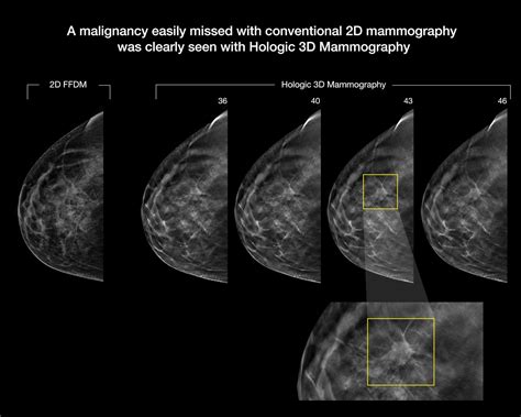 Ob/Gyn Updated : FDA labels Hologic Genius 3D Tomosynthesis Mammography superior for ...