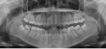 Autogenous Wisdom Tooth Transplantation In Young Patients | OSPublishers