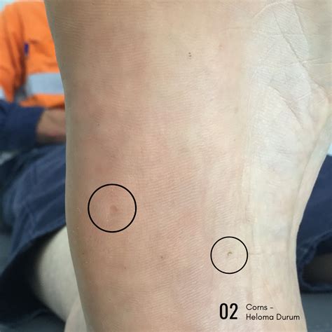 Corn vs. Wart - How to tell the difference! — Sky Podiatry