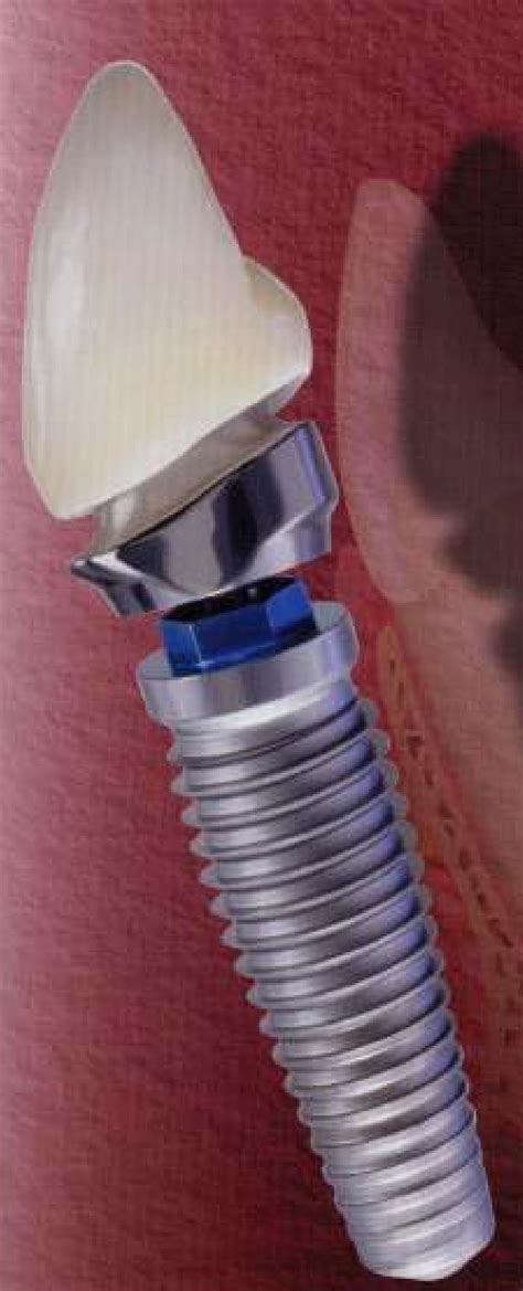 Nobel Biocare Nobel Replace External Hex (Steri-Oss) Implant dentaire ...