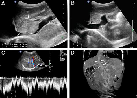 Frontiers | Case Report: Early detection and intervention of congenital portosystemic shunts in ...