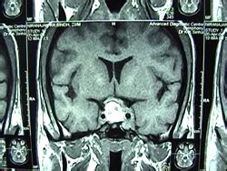Dr. Partha Pratim Bishnu - India / Kolkata, Pituitary Tumor Surgery ...