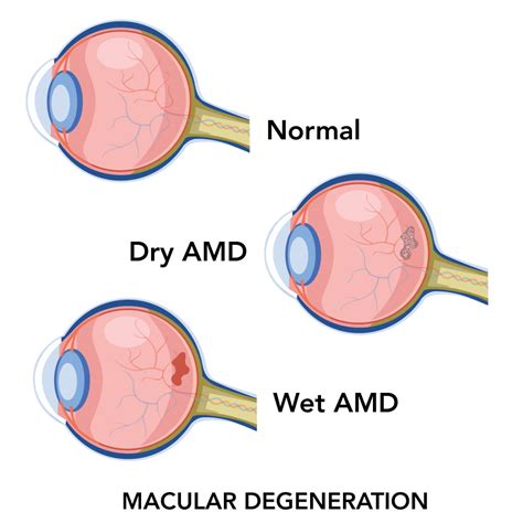 Image result for Macular Degeneration Vision Examples