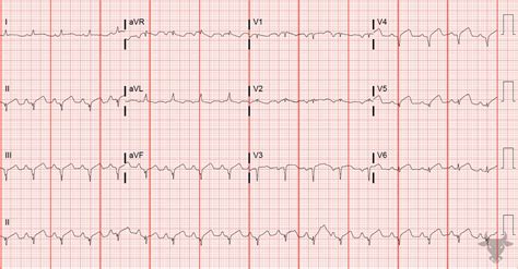 Hyperacute T Waves | ECG Stampede