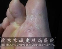 真菌感染是怎么回事_其他皮肤病_北京京城皮肤医院(北京医保定点机构)