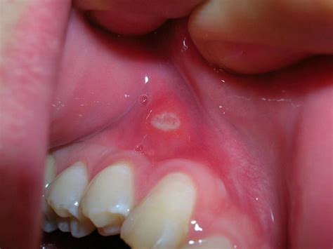 Canker Sore Roof Of Mouth