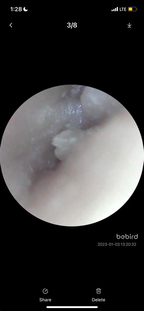 Weird “blood spots” on back of thigh. Bleed profusely for hours when accidentally shaving over ...