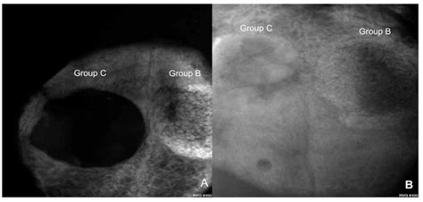 The Use of Human Sterilized Crushed Tooth Particles Compared with BTCP ...