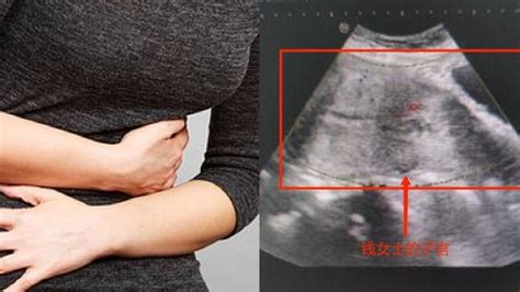 38岁女子误将先兆流产当经期排出，痛失胎儿_凤凰网视频_凤凰网