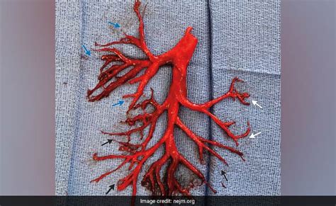 COVID-19 सिर्फ फेफड़े की बीमारी नहीं, इससे खतरनाक तरीके से खून का थक्का ...