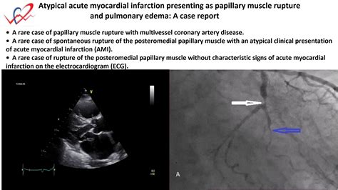 Papillary Muscle Rupture