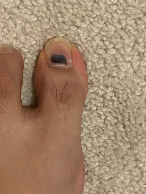What is this black mark on my toenail? Havnt injured my toe recently and I've noticed it growing ...
