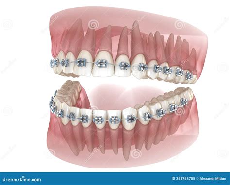 Metal Braces and Transparent Dental Model. Medically Accurate 3D Illustration Stock Illustration ...
