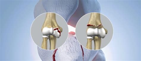 Best Joint Fracture In Bhandara - Dr. Barik's Orthocare Clinic
