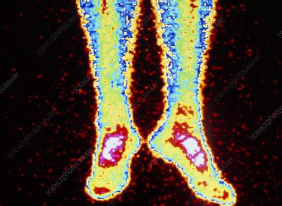 Coloured radionuclide bone scan of lower legs - Stock Image - P830/0028 - Science Photo Library