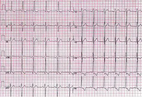 Topic - Electrocardiographic Criteria for Diagnosing Left Ventricular ...