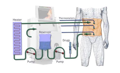 HIPEC Treatment for Colorectal Cancer: Enhancing Outcomes and Improving Survival Rates