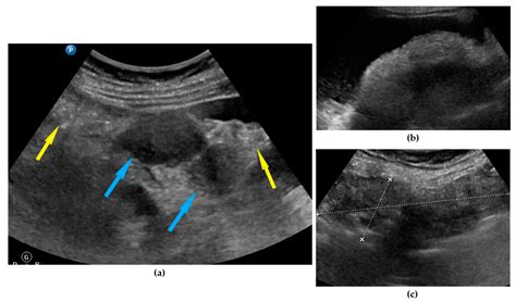 Ovarian Cancer Ultrasound