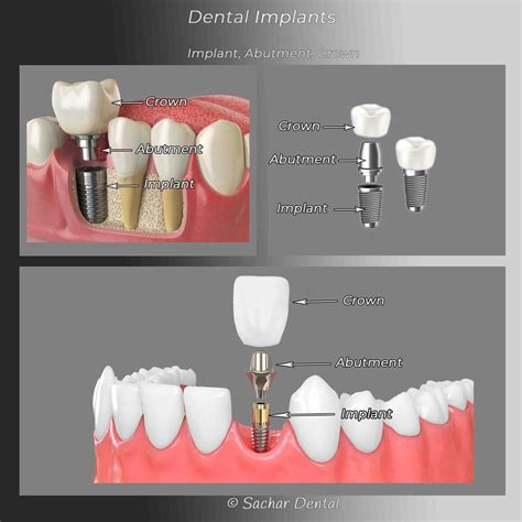Dental Implant Crown